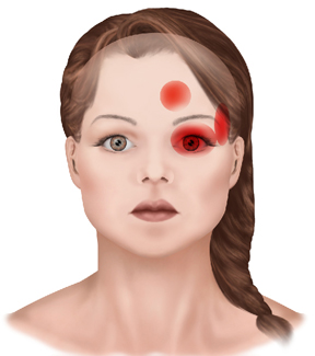 Pain Behind the Left Eye: Causes and Treatments | Just ...